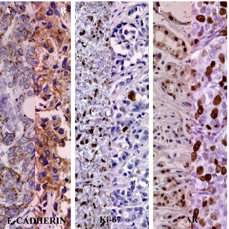 Fig 1. The AR, E-Cadherin and Ki 67 expression in 45 patients TNBC. Legend: [A, B] negative/positive AR staining; [C, D] E-cadherin negative/positive staining; [E, F] Ki-67 level &lt; or  20%.