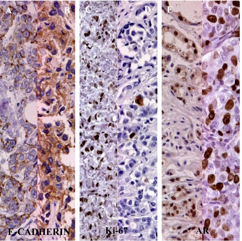 Fig 1. The E-cadherin, Ki-67 and AR expression in 45 patients TNBC. Legend: [A, B] E-cadherin negative/positive staining; [C,D] Ki-67 level &lt; or  20%; [E,F] negative/positive AR staining.