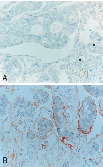 Fig. 2. a. Absence of immunohistcohemical staining for podoplanin around PDC (stars) demonstrates that this histological aspect does not correspond to lymphatic invasion