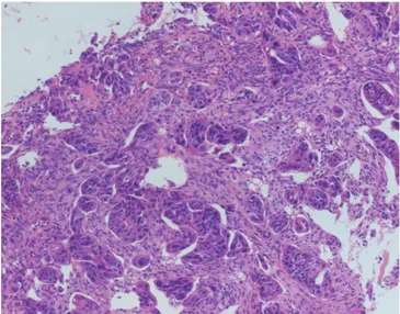 Fig. 3. CRCs graded as G1 (a), G2 (b) and G3 (c) according to PDC grading. H&amp;E stain