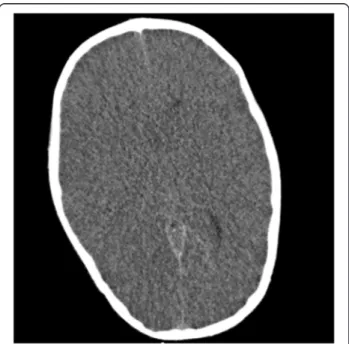 Figure 1 CT scan of the brain. Loss of cortical convolutions; reduction of cisternal cerebral spaces; reduced gray to white matter tissue intensity contrast.