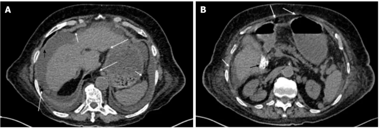 Figure 1  CT scan findings. A: Evidence of an important abdominopelvic peritoneal effusion (black arrowhead), perigastric free air along the gastrocolic ligament and 