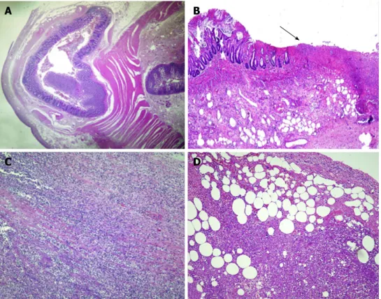 Figure 3  Histological findings. A: The whole histological section shows a diverticular structure consisting of mucosa and submucosa with a small rim of longitudinal 