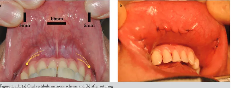 Figure 1. a, b. (a) Oral vestibule incisions scheme and (b) after suturing ba