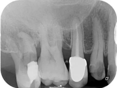 Fig. 2 (Group 1)  x-Ray of a patient in need to restore the first premolar and to extract the second  molar.
