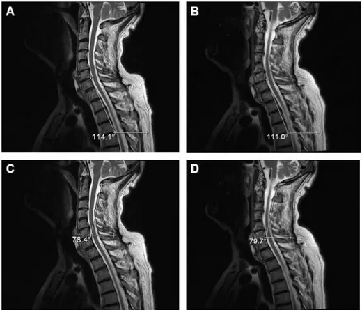 Figure  3.  Pre-exercise  (A  and  C)  and  post-exercise  (B  and  D)  magnetic  resonance  imaging  (MRI)  images  (sagittal  T2  weighted  fast  spin  echo  images;  TR/TE-4000/105)  of  one  representative  subject  who performed the motor task daily (