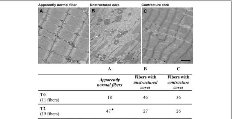 FIGURE 6 | Appearance of skeletal fibers in electron microscopy (EM). Fibers were classified by EM for the quantitative analysis in different categories: (A) apparently normal fibers (A) with a typical pale-dark striation; (B) fibers with unstructured core