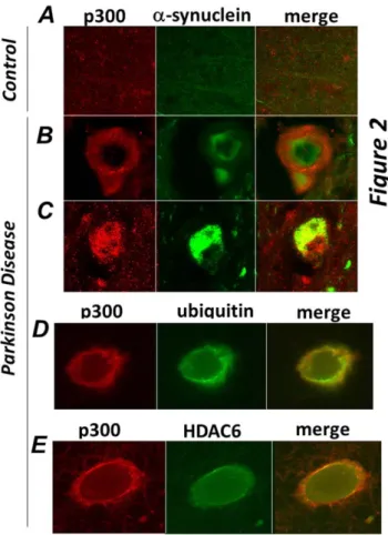 Figure 2. p300 co-localizes with a-synuclein, ubiquitin and HDAC6 in brain of patients affected by Parkinson Disease