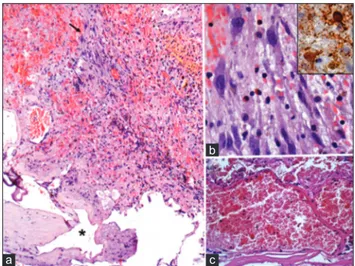 Figure 2: Case 1. (a) distinct tumor types in this picture, depicting  ganglioglioma mixed with cavernous angioma at the bottom 