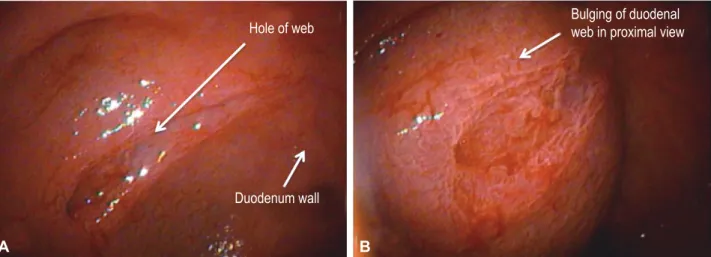 Fig. 2. Case 3: 10-year-old girl. (A, B) An upper gastrointestinal contrast study shows a duodenal stenosis with delayed emptying of the 2nd duodenal portion (red  arrow) and all of the small bowel in the right quadrant and the colon in the left quadrant b