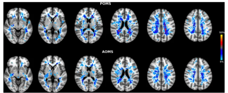 FigUre 1 | Lesion probability map (LPM) in early adult pediatric-onset multiple sclerosis (POMS) with no or minimal disability (top) and age- and disability-matched 