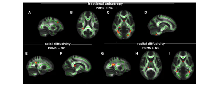 FigUre 2 | Tract-based spatial statistics analysis of differences in diffusion tensor imaging (DTI) measures between early adult pediatric-onset multiple sclerosis 
