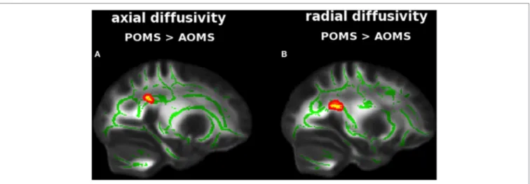 FigUre 3 | Tract-based spatial statistics analysis of differences in diffusion tensor imaging (DTI) measures between early adult pediatric-onset multiple sclerosis 