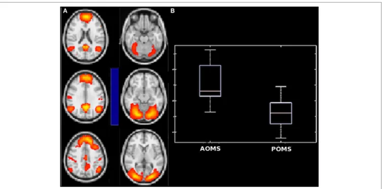 FigUre 5 | Difference in internetwork functional connectivity between early adult pediatric-onset multiple sclerosis (POMS) with no or minimal disability and age- 