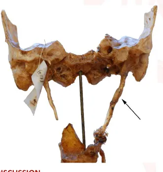 Fig. 1:  Arrow pointing the elongated styloid process and calcified  stylohyoid  ligament.