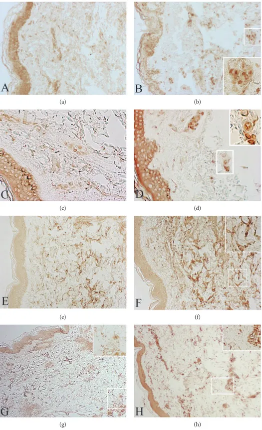 Figure 3: Skin biopsies from MDE patient (b, d, f, and h) and healthy donor (a, c, e, and g)