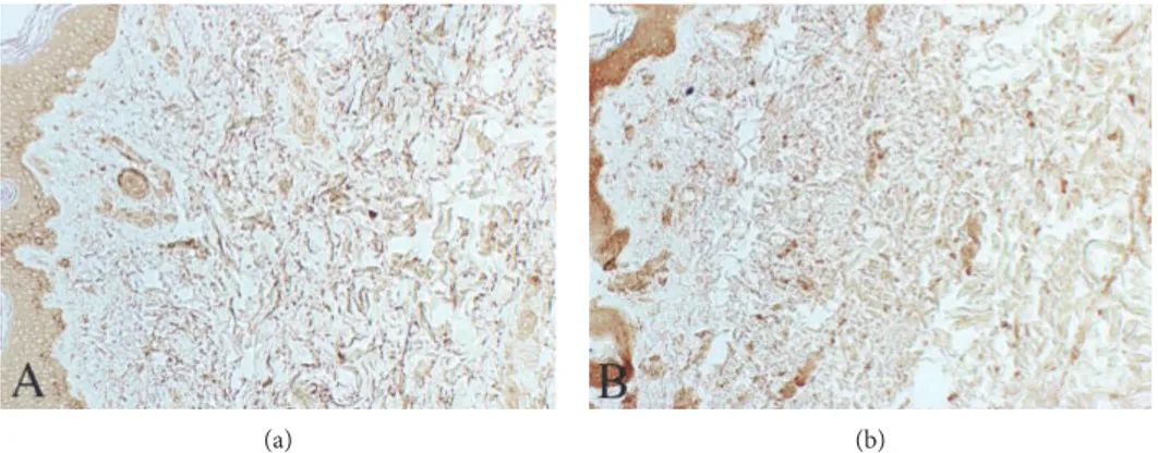 Figure 4: Representative skin samples from control subject (a) and MDE patient (b) after immunoreaction for MMP-1