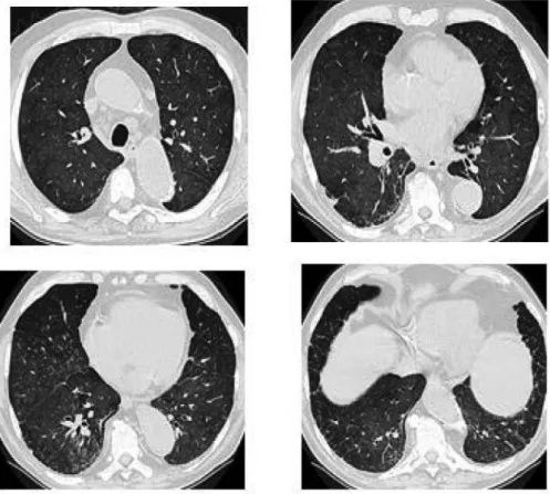 Figure 1. High-resolution computed tomography of the chest showing diffuse ground-glass opacities (a), bilateral peripheral reticulations (b), areas of subpleural thickening (c), and bilateral centrilobular low-density nodules (d).