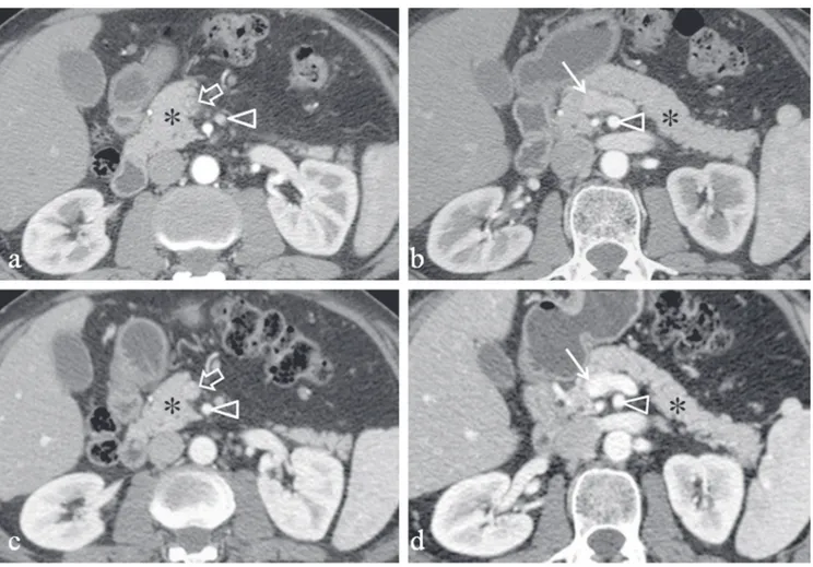 Figure 2. 60-year-old man with normal pancreas. Pancreatic parenchymal phase during triphasic (a,b) mDcT and combined arterial-venous  phase of the split-bolus (c,d) mDcT technique