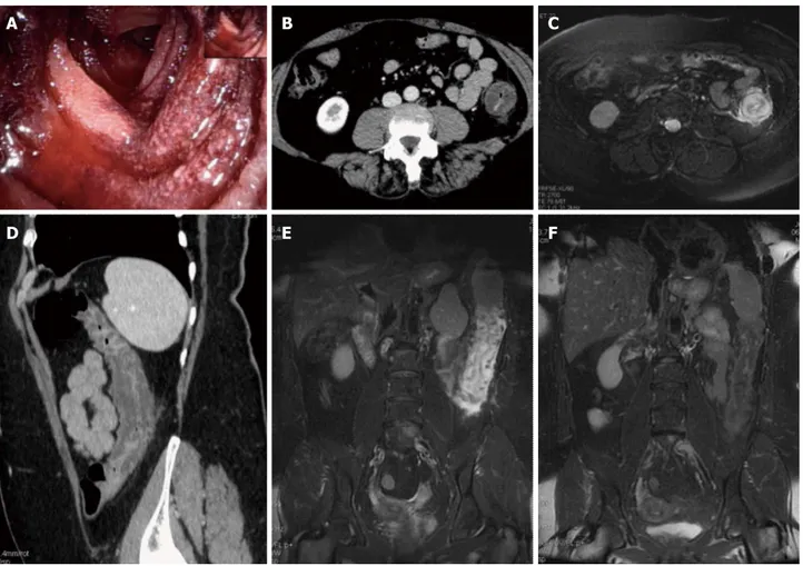Figure 1  Magnetic resonance imaging follow-up of a patients with ischemic colitis resolved promptly