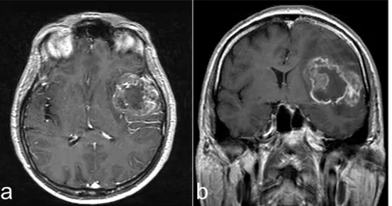 Fig. 1. Preoperative contrast-enhanced MRI. Axial (a) and coronal (b) images, compatible with high grade glioma.