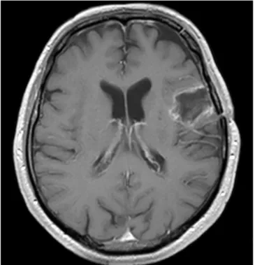 Fig. 4. Follow-up MRI. Fifteen months after surgery, there is no evidence of recurrence on contrast-enhanced MRI.