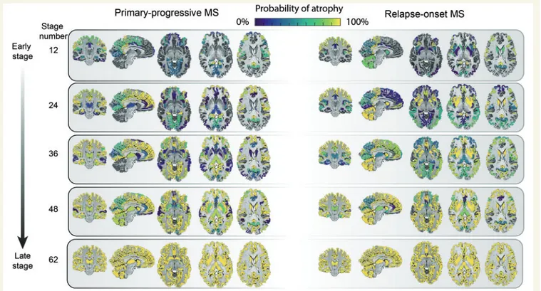 Figure 4 Regional atrophy and its sequence of progression in all grey matter regions plus brainstem in relapse-onset disease and primary progressive multiple sclerosis