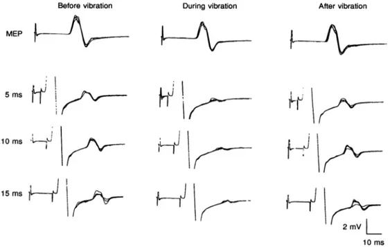 Figure 4. Effect of vibration of the ADM tendon on MEP and H reflex under resting conditions