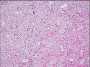 Figure 1: The tumor was composed of atypical cells arranged in 