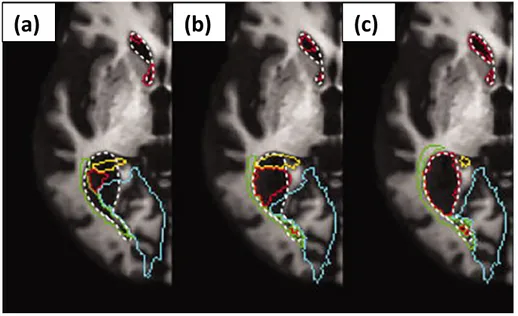 Fig. 3. The eﬀect of grey/white contrast on cortical thickness measurement using FreeSurfer