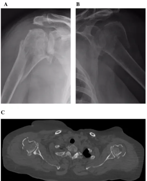 Fig. 1. X-rays showing the four-part fracture of right (a) and left (b) proximal humeri, and bilateral CT scan on axial (c) and coronal (d) plan