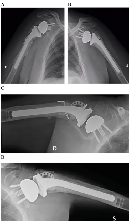 Fig. 2. X-rays at 1-year FU of the right (a) and left (b) shoulder. X-rays were taken in the position of maximal active abduction, as well, for both (c, right; d, left) sides.
