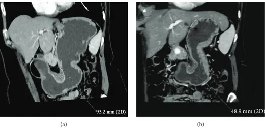 Figure 7: (a, b) GC cancer of the angulus (diﬀuse histotype) in a 69-year-old woman. TRG 2 was found on ﬁnal pathology after NAC.