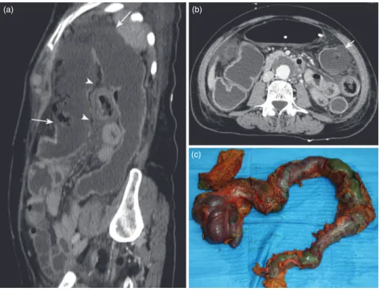 Fig. 1   Abdominal CT and surgical specimen of a clinical case of NOMI after major cardiovascular 