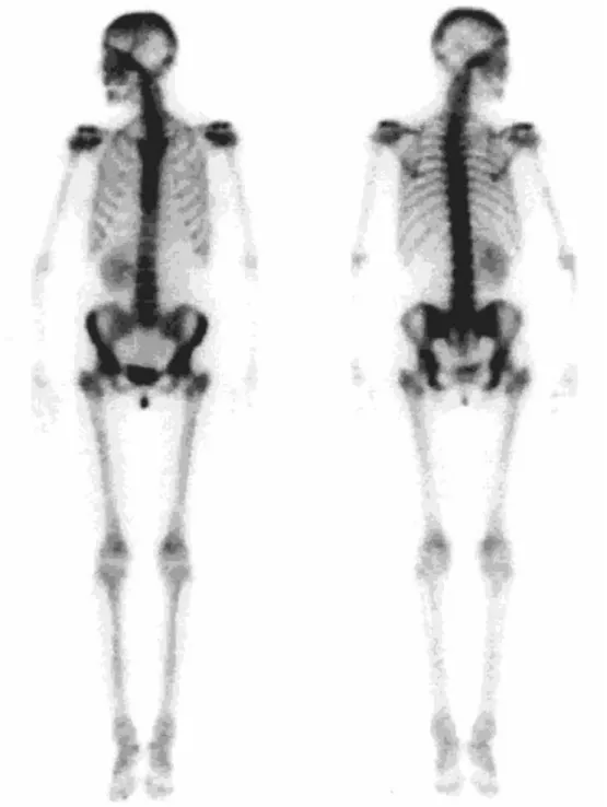 Fig. 2 Radionuclide imaging ( 99m Tc methylene bisphosphonate) of patient IV-1: absence of the left kidney and hypertrophic right kidney.