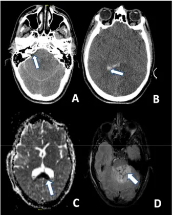 Figure 3. CT at 6 h after the trauma: (A) Absence of the basal cisterns (arrow); and (B) massive brain 