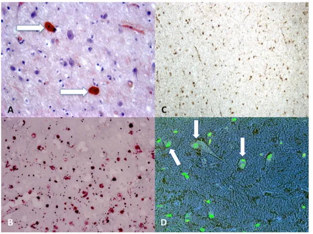 Figure 2. (A) Scattered axonal retraction balls stained with Congo Red (arrows), scale bar: ×250; (B)  diffuse β-APP positivity expression in the corpus callosum is an indicator of axonal injury (grade II),  scale bar: ×80; (C)  β-APP (brown reactions) rea