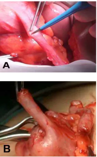 Fig. 3 A, B. Performing of appendicocecostomy.  An anastomosis of the skin, after a star-shaped  incision  was  performed,  to  the  apex  of  the  spatulated appendix  with  creation an ACE as 