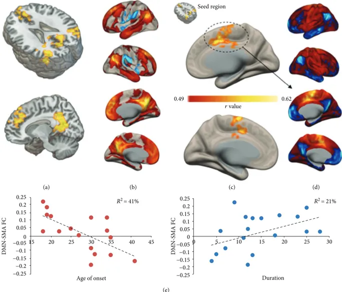 Figure 2: Correlation with clinical scores. Results of the voxel-wise correlation between FC patterns and age of onset are shown in (a), highlighting a set of clusters closely resembling the default mode network (DMN), as conﬁrmed by the seed-based connect
