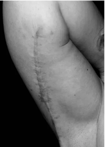 Figure 5. Wide and hypertrophic scar after brachioplasty