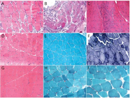 Figure 3 Myopathologic changes in patients with limb-girdle muscle weakness (top row, A–C), myalgia, and exercise