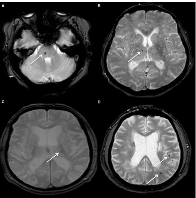 Fig 2. Examples of different locations of cerebral microbleeds in our sample of CADASIL patients
