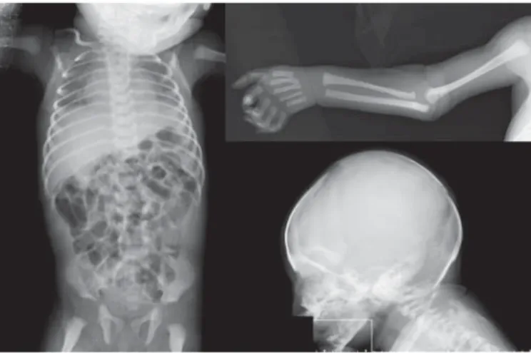 Fig. 2.   Radiographs of the patient showing hooked clavicles, slen- slen-der ribs, and long bones