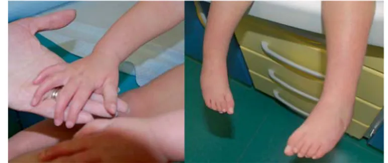 Fig. 3.   Proband at 1 year of age and at 2 years 9 months.     Fig. 4.   Hands and feet of the proband at 2 years 9 months