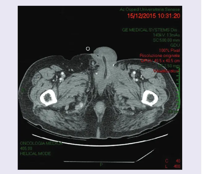 Figure 2. Abdomen CT scan performed in December 2015 showing a pathological nodule of maximum 25 mm in size along the left gonadal vessels, about 6 cm from the outlet in the ipsilateral renal vein.