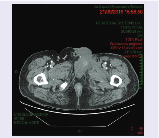 Figure 3. Abdomen CT scan performed in September 2016 after eribulin treatment and revealing the outcomes of the recent surgery at level of the inguinal region, with a reduction of the homolateral hernia (residual herniation of the bladder) and evidence of