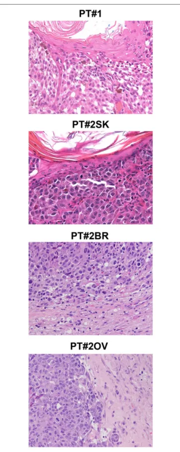 FIGURE 1 | Melanoma histology in Patient 1 (PT#1) and Patient 2 (PT#2) at different sites