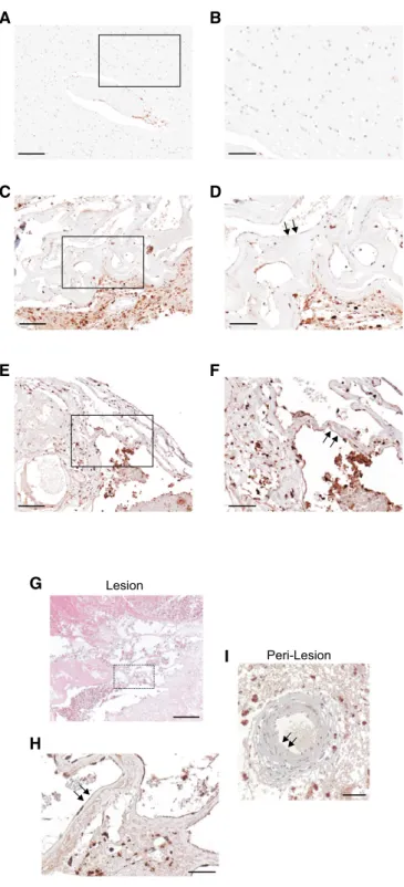 Figure 4. Accumulation of p62 in endothelial cells lining human CCM lesions.