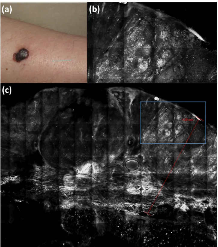 Figure 7. Clinical (a) and ex vivo reflectance confocal microscopy (b, c) aspects of melanoma