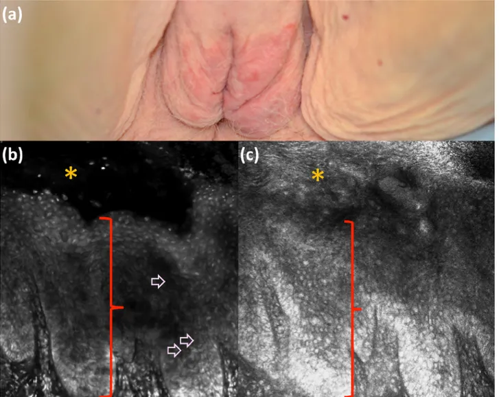 Figure 8. Clinical (a), fluorescence (b), and reflectance (c) ex vivo reflectance confocal microscopy aspect of Paget’s disease
